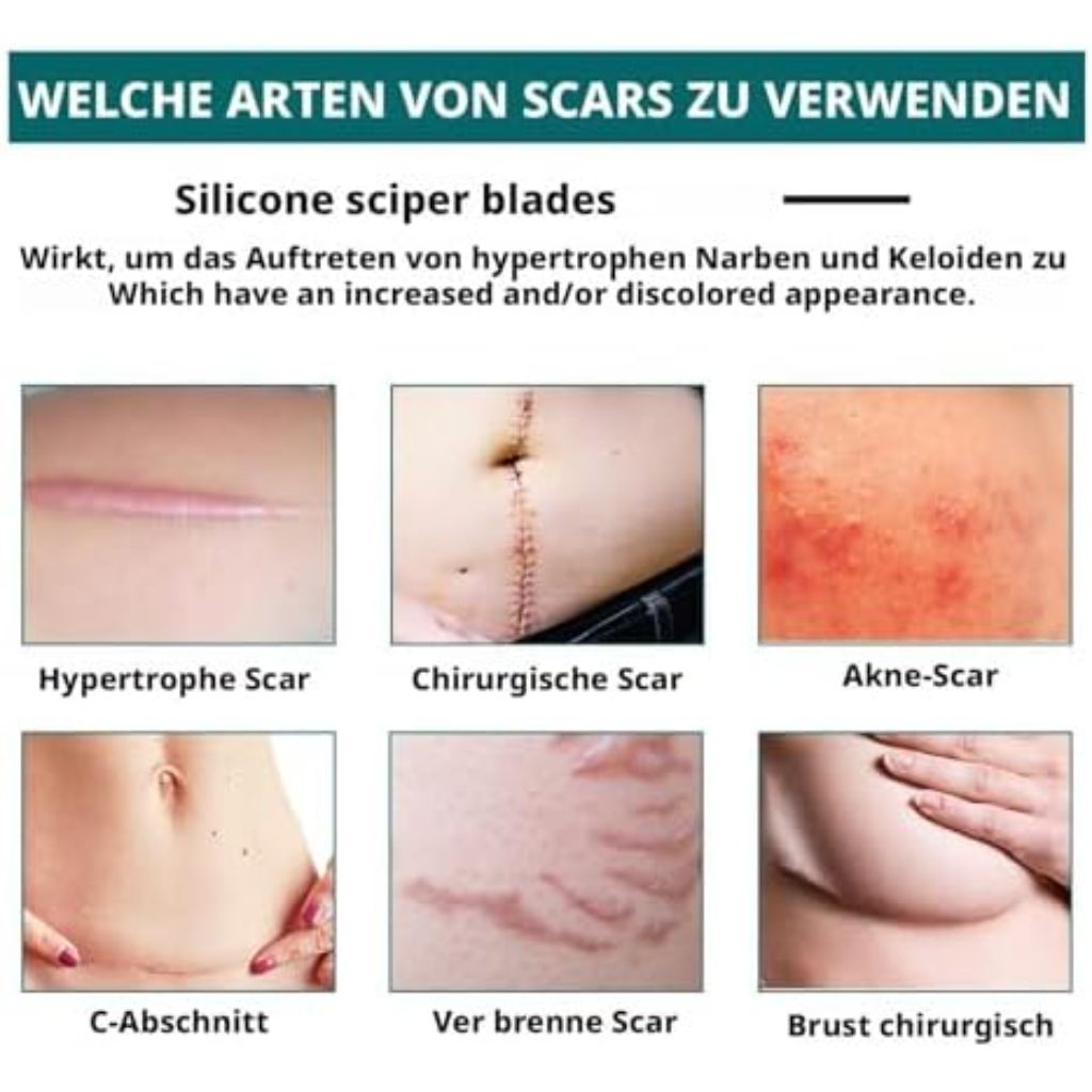 Silicone Scar Tape, (1.6X116 inches), Silicone Scar Tape for Scar Removal Treatment, Suitable for Caesarean Section, Scars, Burns, Acne, Surgical Scars