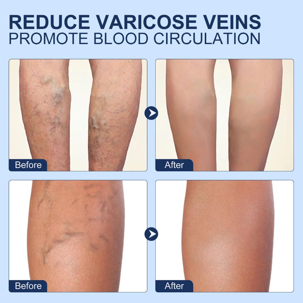 Dermfree Varicose Veins Max Strength Treatment Cream - 2.1oz.