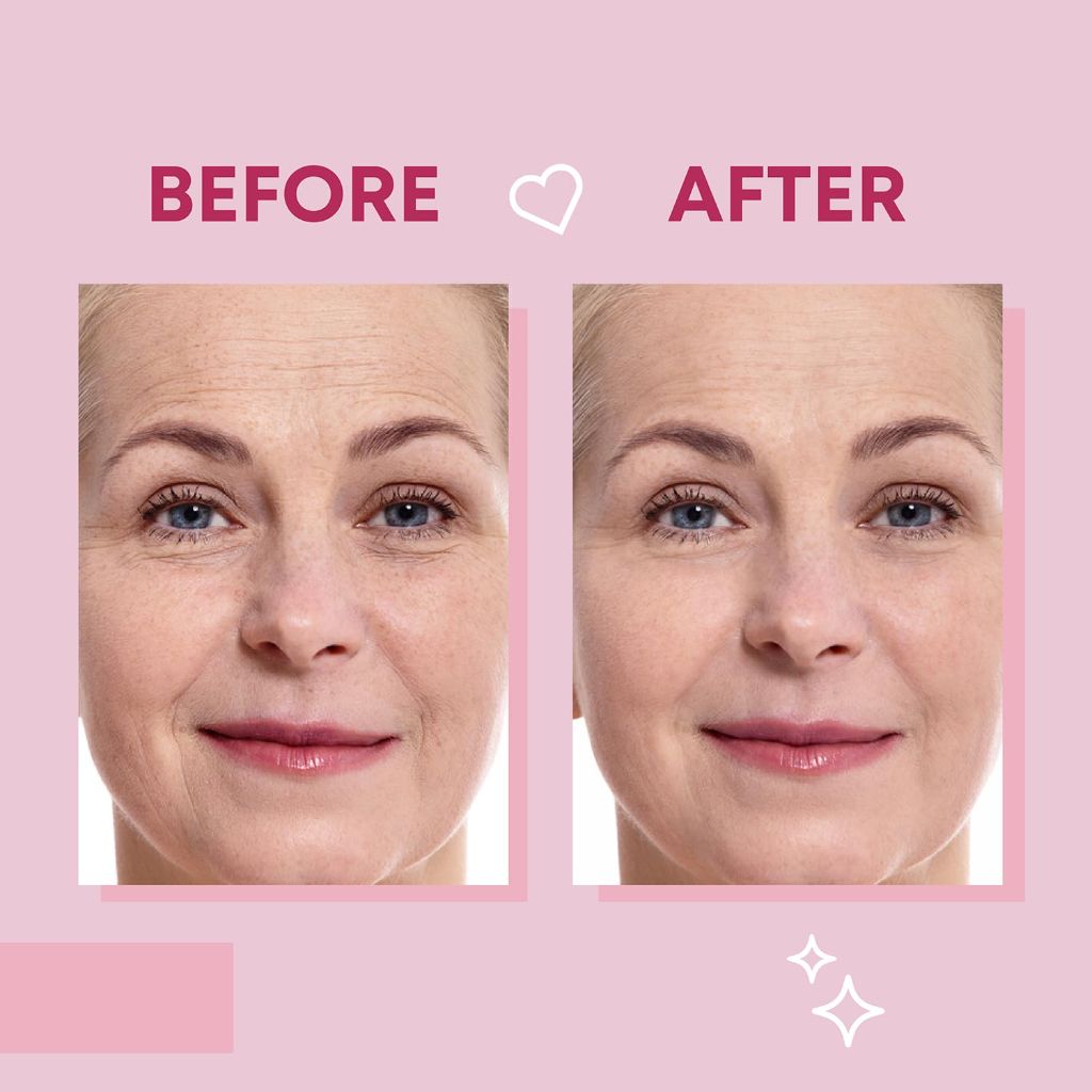 Line Patches Forehead Wrinkle and Smile Line Patches Set - 36ct – Blitzstock