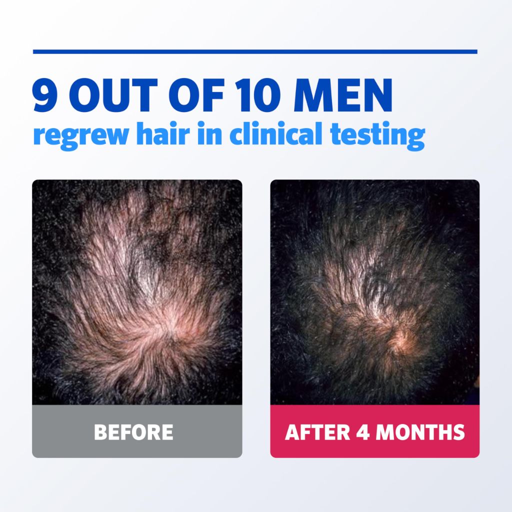 Men’s Rogaine 5% Minoxidil for Men Foam, Clinically Proven Regrowth for Thinning Hair, 3 x 2.11 oz