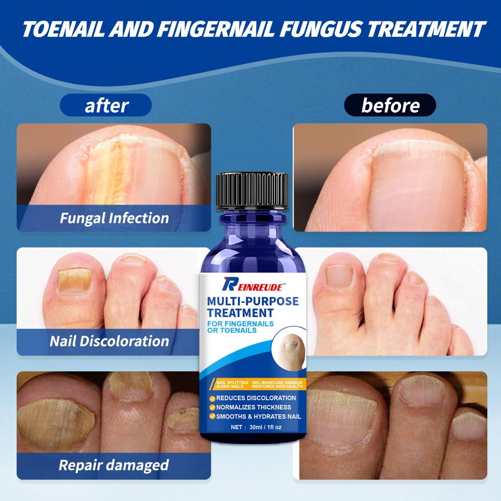 REINREUDE Toenail Fungus Treatment Extra Strength - Safely and Gently,30ML