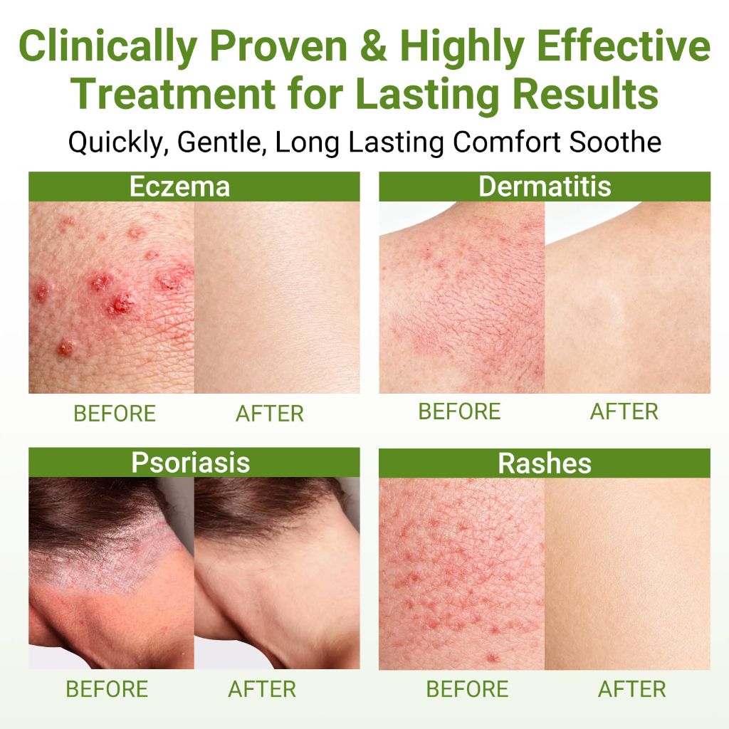 HOMWIS Eczema Cream, Psoriasis, Dermatitis & Rashes Treatment, 3.53 OZ