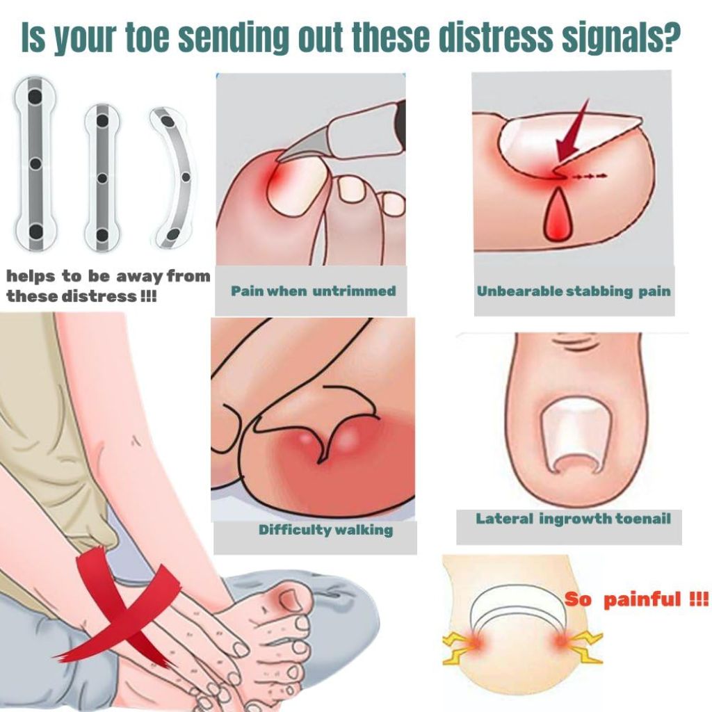 Ingrown Toenail Corrector & Removal Kit