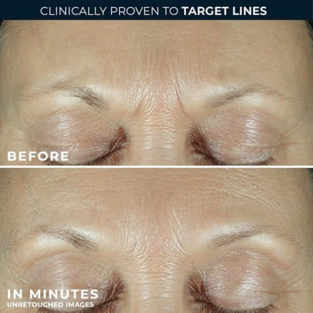 RoC Derm Correxion Fill + Treat Advanced Retinol Serum, Wrinkle Filler Treatment with Hyaluronic Acid for Crow's Feet, 11 Wrinkles, & Laugh Lines, (.5 fl oz) with Retinol Packette (Packaging May Vary)