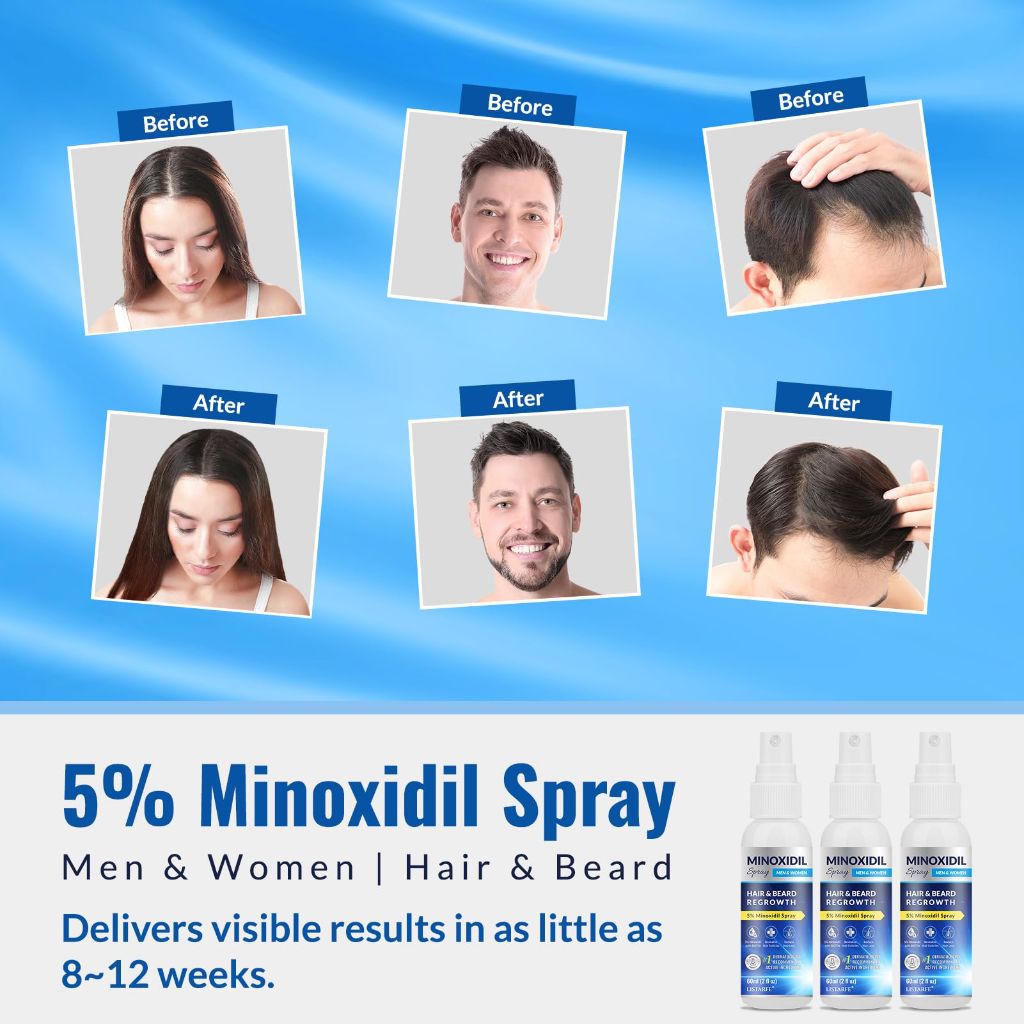 5% Minoxidil Spray for Hair and Beard - 2 fl. oz. (3 Pack)
