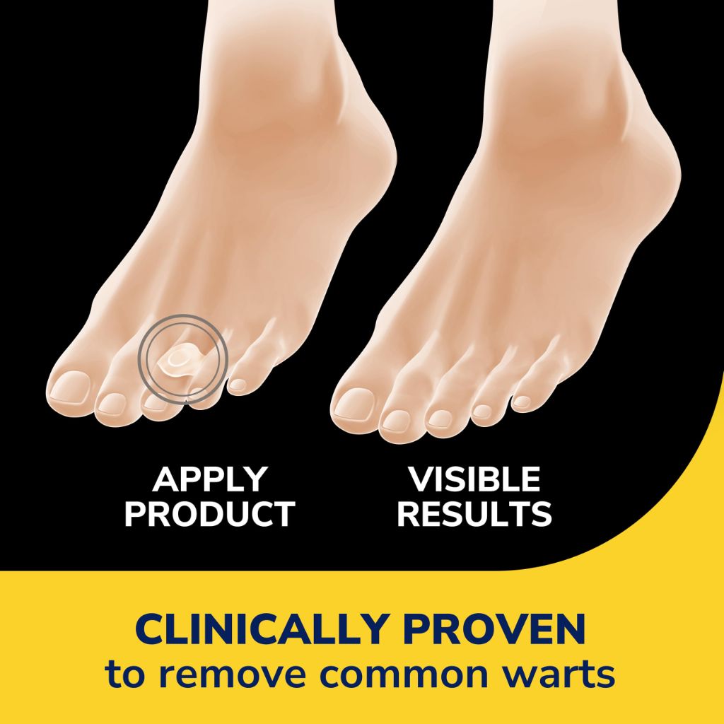 Dr. Scholl’s Clear Away Wart Remover Hydrogel Bandages
