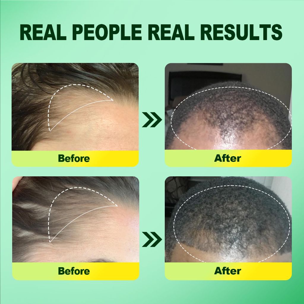 Minoxidil Hair Growth 2Pack