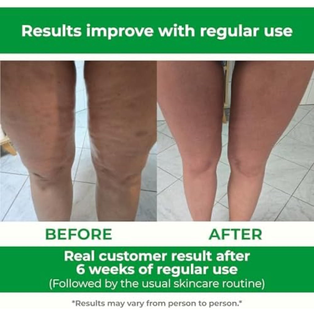 TESMED Cellulite Manual Massager : Made in Italy, Patented with Converging & Diverging Roller Technology. Anti Cellulite Roller for Thighs and Buttock