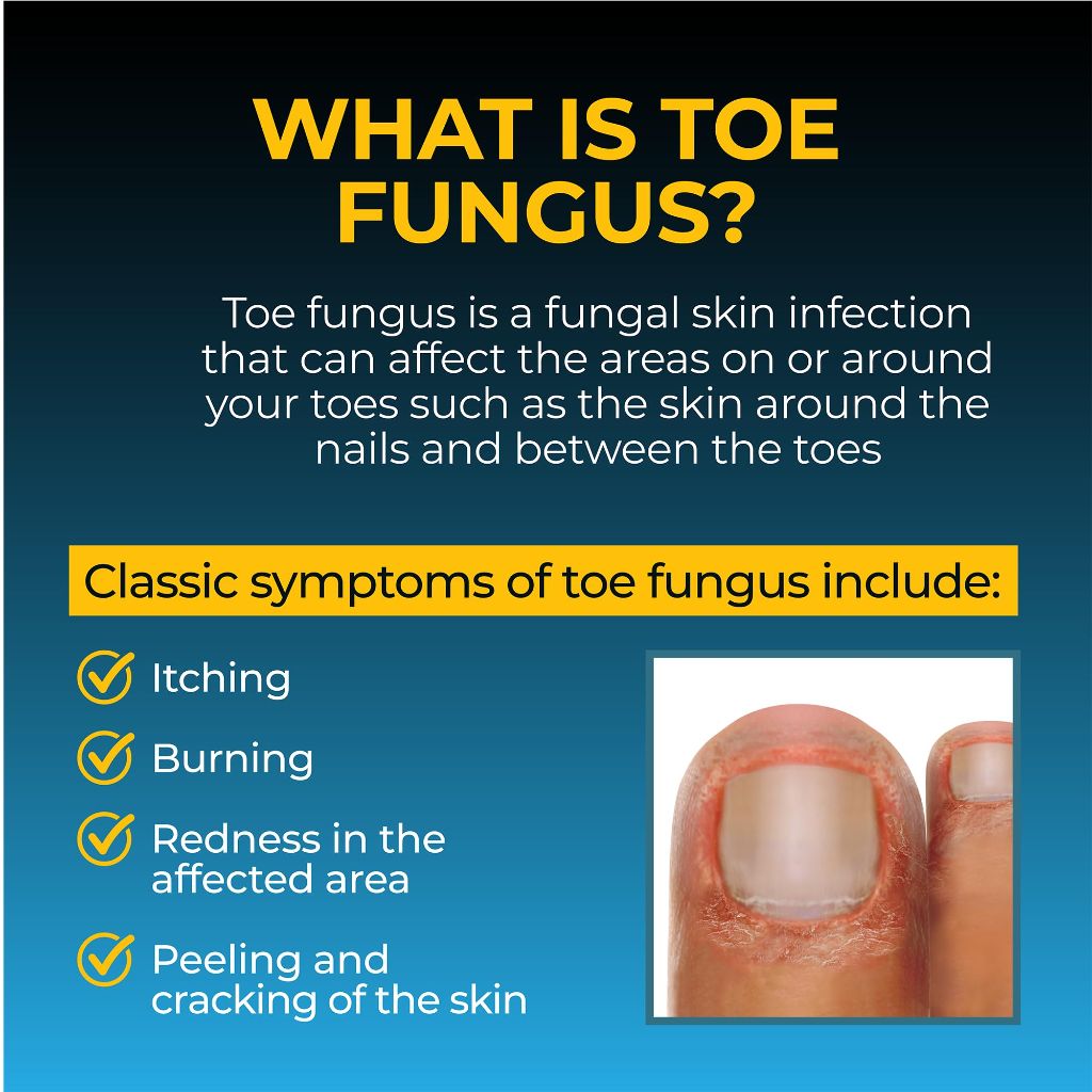 Fungi Nail Anti-Fungal Ointment, Clinically Proven to Cure and Prevent Fungal Infections, | 0.7 Fl Oz