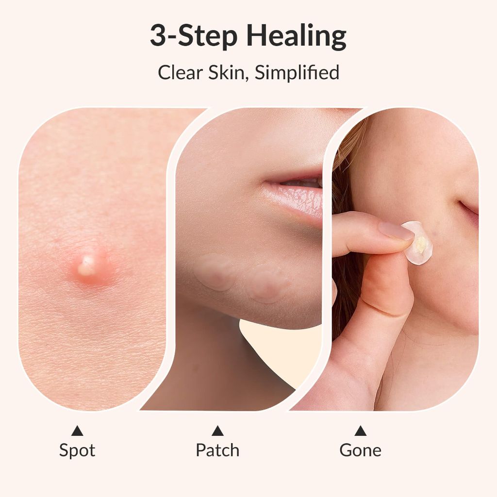 RPE Life Invisible Pimple Patches – 144 Patches