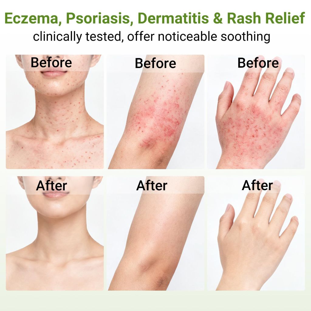 HOMWIS Eczema Cream, Psoriasis, Dermatitis & Rashes Treatment, 3.53 OZ