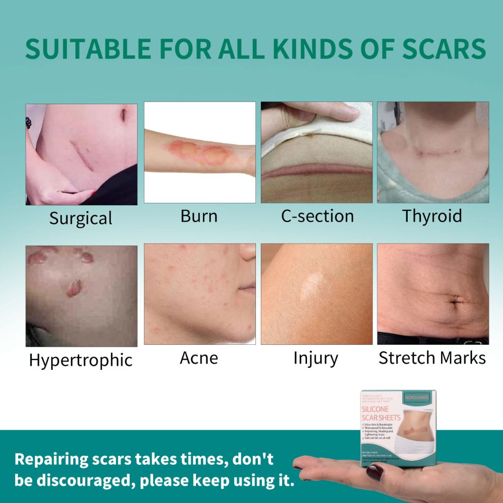 Norsumkn Silicone Scar Tape 1.6"X 60"