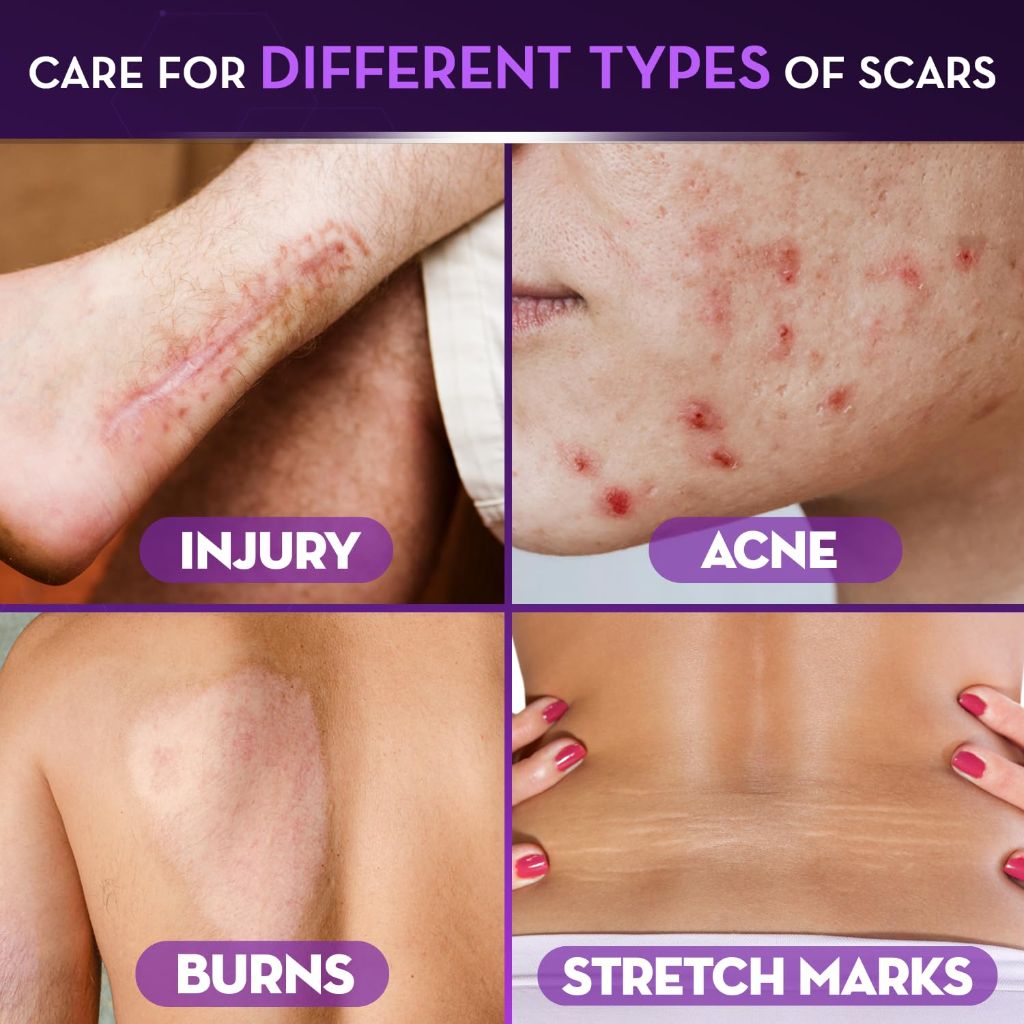 Cicatricure Advanced Scar Gel for Face & Body, Acne Scar Treatment, 2 oz (56g)