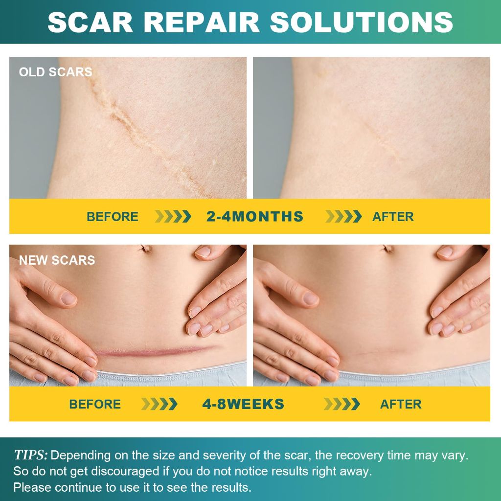 Silicone Scar Tape, Silicone Scar Sheets(1.6"X 59" Roll-1.5M), Silicone Scar Sheets for Face