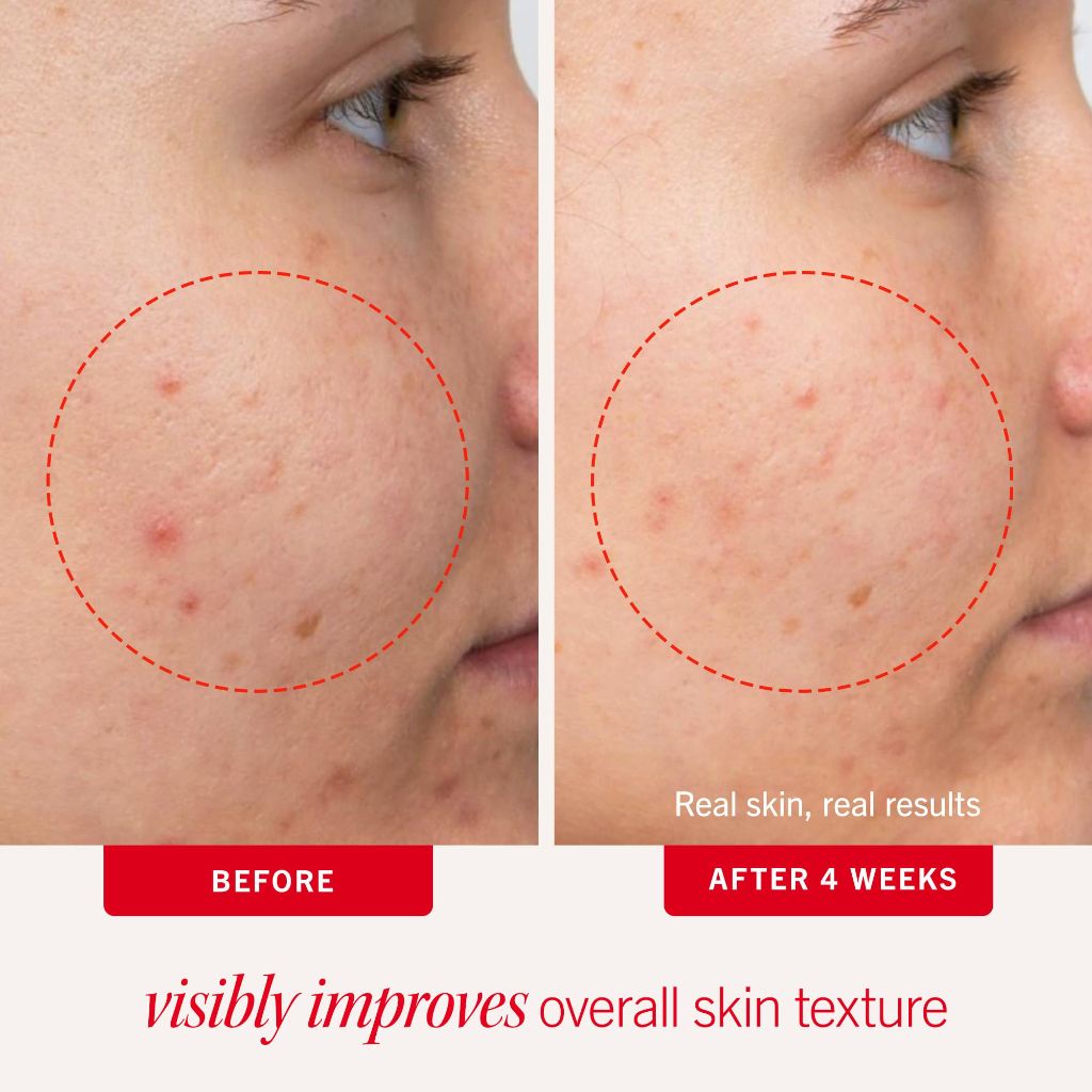 First Aid Beauty Acne Pads for Face, 2% Salicylic Acid Pads Treat Without Drying (60ct)