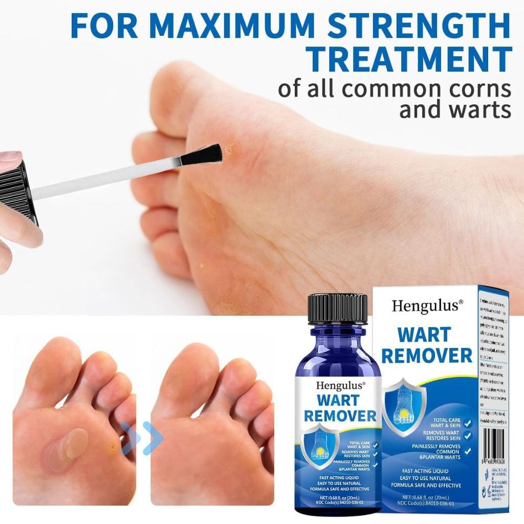 Wart Removal Cream,Salicylic Wart Remover