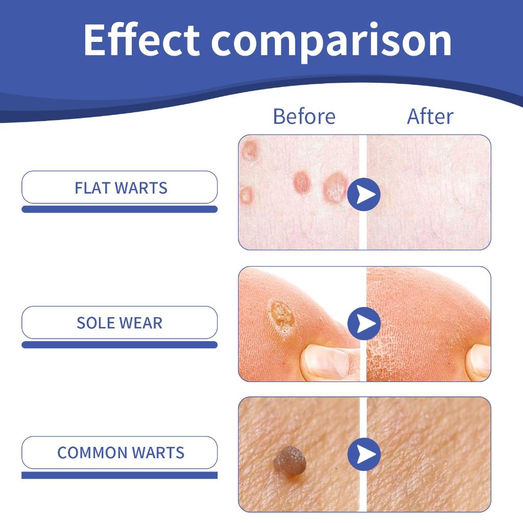 Likluc Fast-Acting Wart Remover Gel