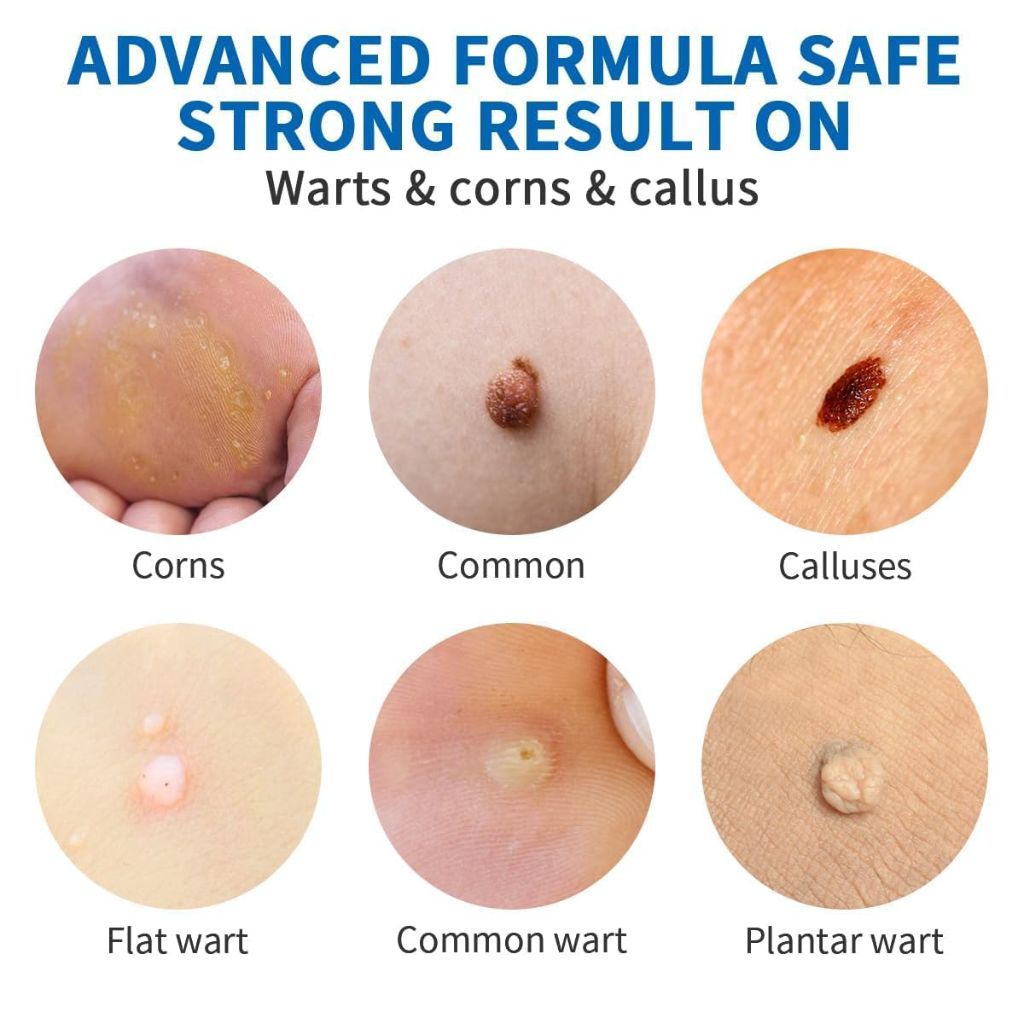 Wart Removal Cream,Salicylic Wart Remover