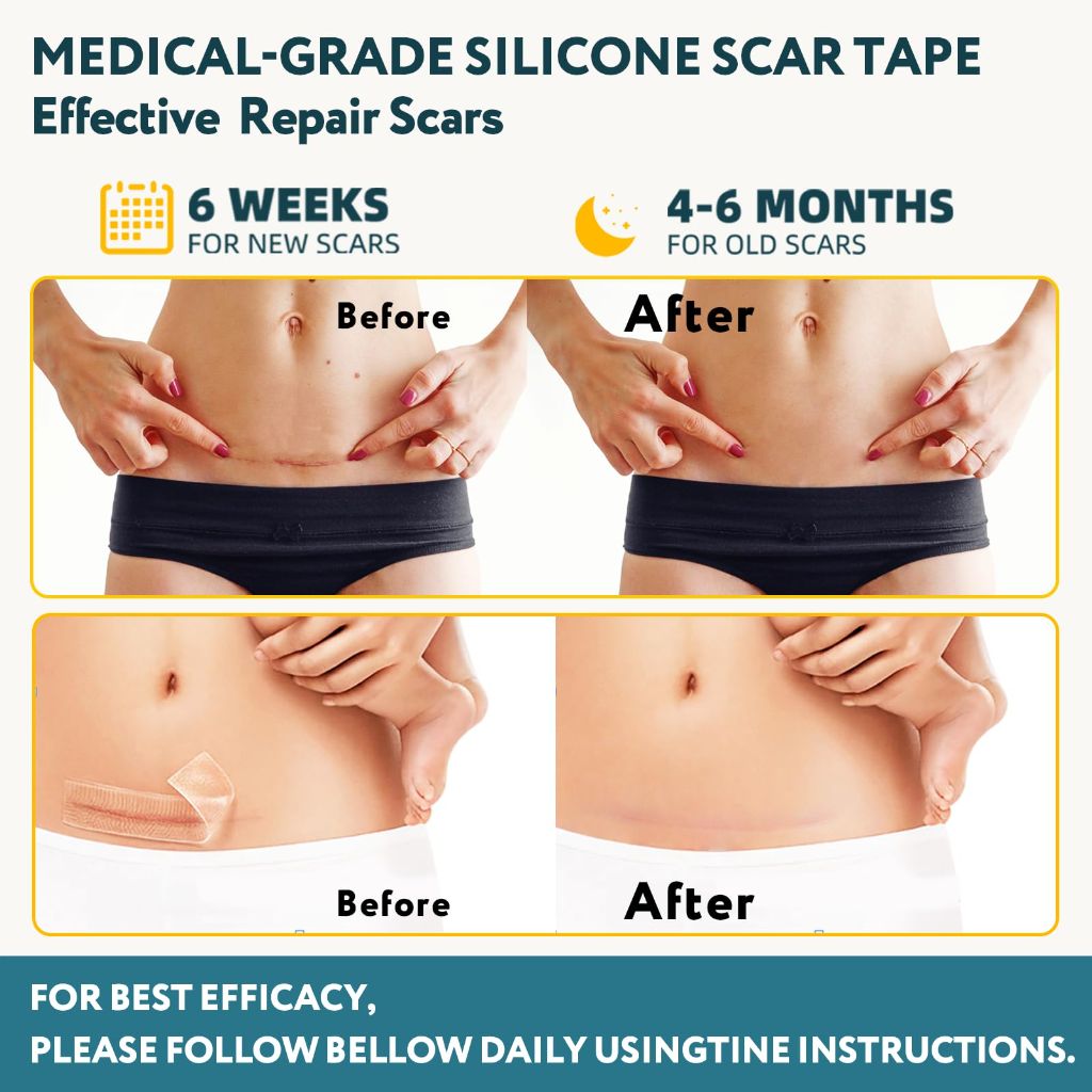 Silicone Scar Tape - 60" x 1.6" Roll - 1.5M, Scar Treatment - Medical Grade Reusable Silicone Scar Sheets