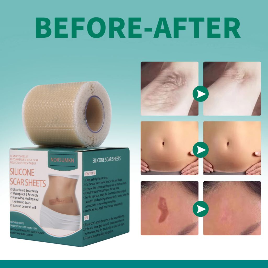 Norsumkn Silicone Scar Tape 1.6"X 60"