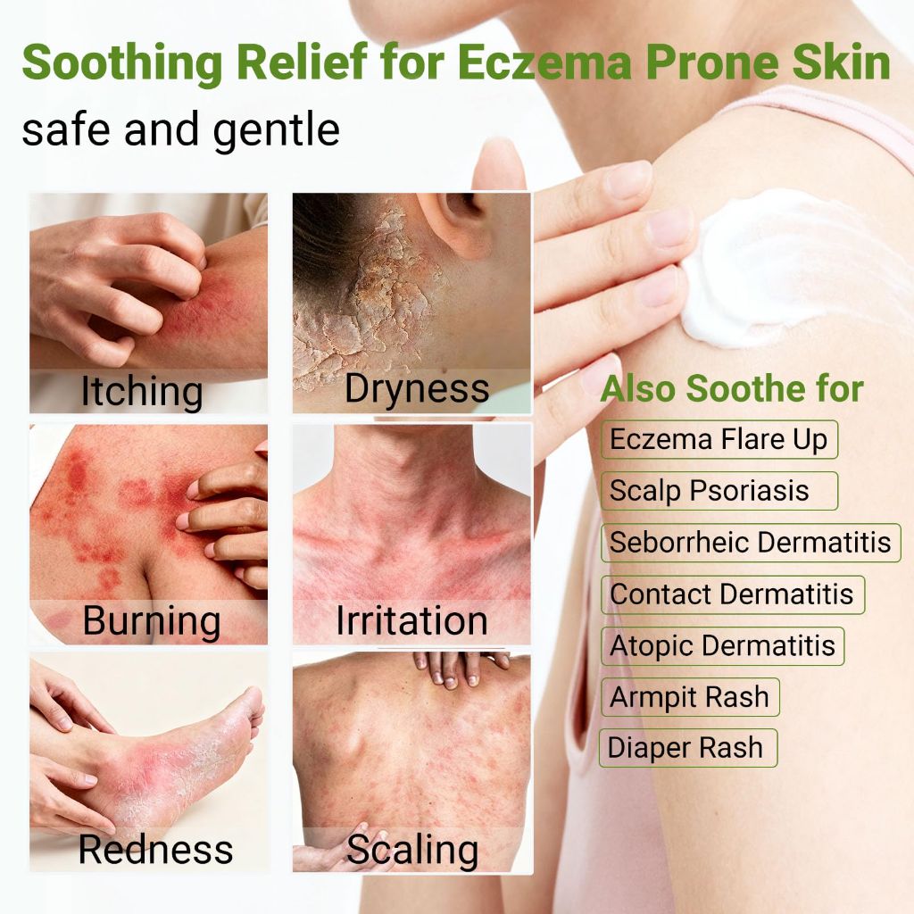 HOMWIS Eczema Cream, Psoriasis, Dermatitis & Rashes Treatment, 3.53 OZ