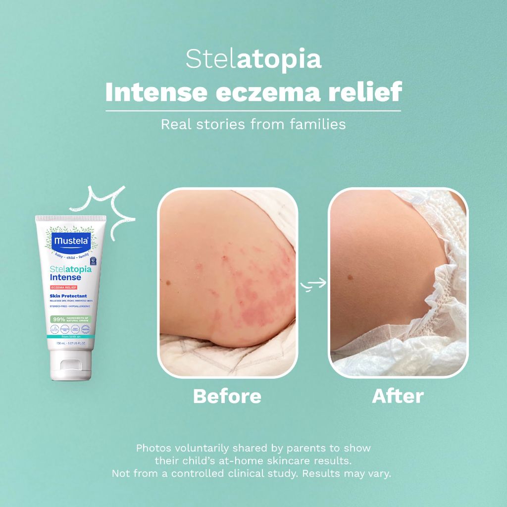 Mustela Stelatopia Intense Eczema Relief Cream, Fragrance-Free with Colloidal Oatmeal - 5.07 fl. oz.
