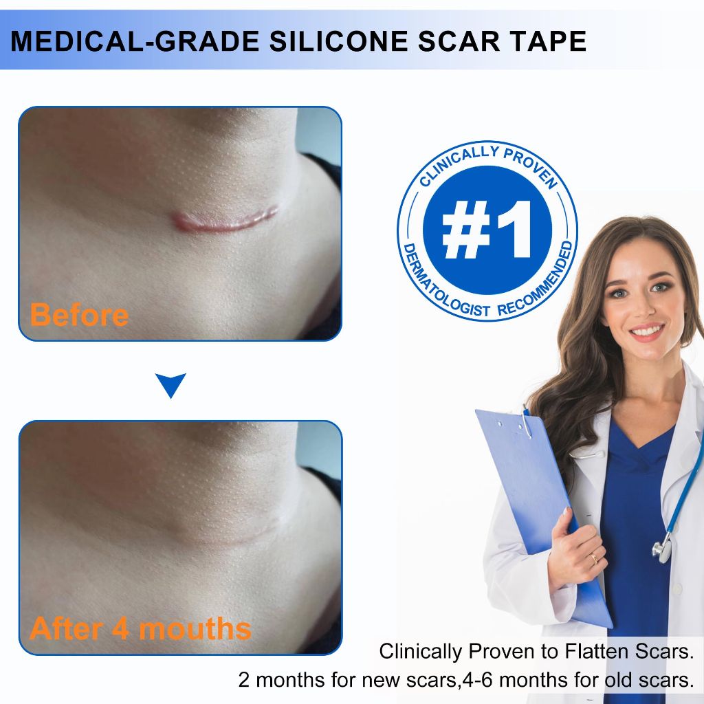 Silicone Scar Tape for C-Section Recovery Medical Grade Silicone Scar Sheets for Surgical Scars Hyperplastic Tummy Tuck Keloid 1.6" x 59"