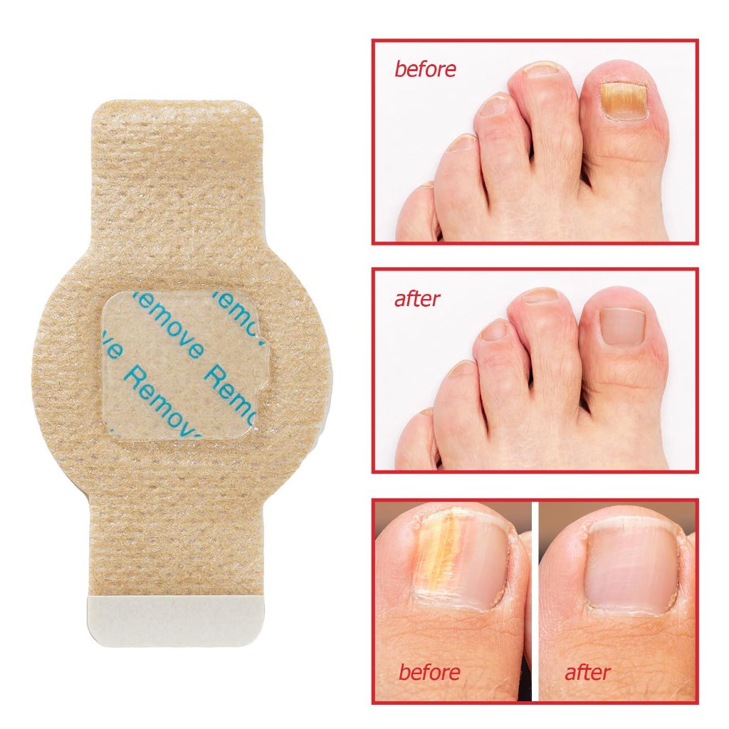 Fungal Nail Patches for Toenails, Extra Strength Overnight Care - 21ct.